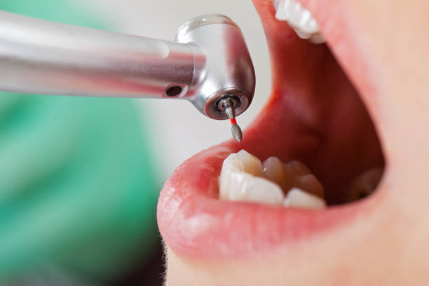 Best Emergency Dentist for Lost Fillings or Crowns in Canutillo, TX